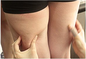 허벅지 뒤쪽 셀룰라이트를 두 손으로 잡아 보는 사진
