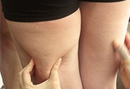 허벅지 뒤쪽 셀룰라이트를 두 손으로 잡아 보는 사진